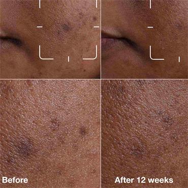 EVEN BETTER CLINICAL DARK SPOT CLEARING SERUM