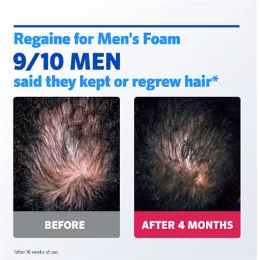 Regaine For Men (minoxidil) Foam 1 Month Supply
