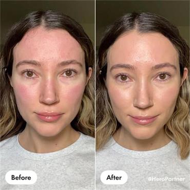 Hero Rescue Balm Red Correct 15ml